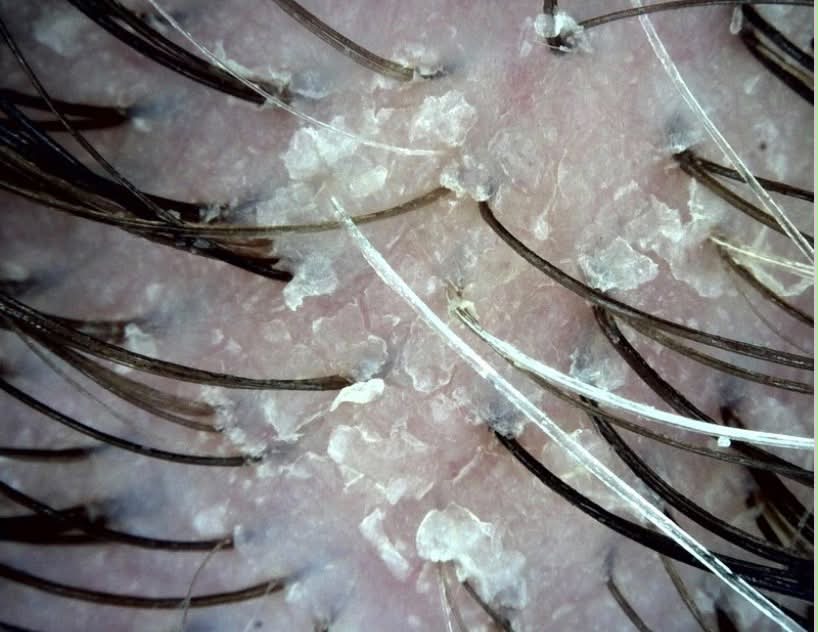 Zdjęcie trichoskopowe skóry głowy z pierwszej wizyty: widoczne łuski naskórka